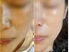 【人気NO.1】厚塗りファンデ卒業◎本気のシミ集中ケア　￥18,000→9,800