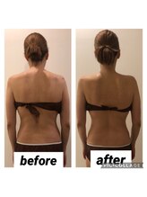 ノイル(noir)/ハイパーナイフの施術