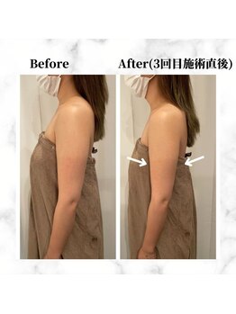 ザビューティー 麻布十番本店(The Beauty)/二の腕リフト打ち放題[リフト]