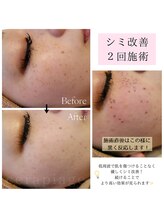セラピエージ/シミ改善ビフォーアフター◎