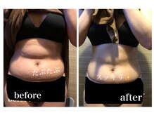 ライズサロン(RiseSALON)/【お腹くびれ】症例