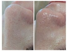 アン(anne)/毛 穴 洗 浄×3回目☆