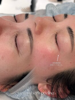 エナム(enam.)/ハーブピーリング一回で効果実感