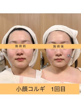 オプレア 栄店(OPREA)/比較写真【小顔コルギ】