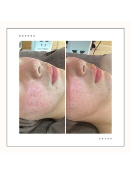 シュエット(Chouette)/ハーブピーリング