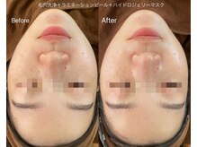 リアン(Lien)/水光肌ピーリング