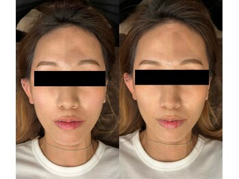 やまぐち鍼灸整骨院 千里山院/美容鍼