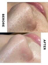 ターミナルジム アンド ビューティーサロン(TERMINAL GYM&BEAUTY SALON)/毛穴洗浄×毛穴ケア