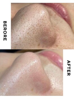 ターミナルジム アンド ビューティーサロン(TERMINAL GYM&BEAUTY SALON)/毛穴洗浄×毛穴ケア