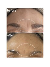 ウィッシュプロサロンケー(WISHpro salon K)/眉間シワ