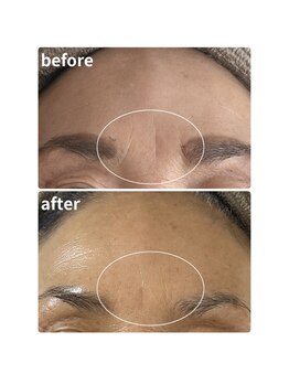 ウィッシュプロサロンケー(WISHpro salon K)/眉間シワ