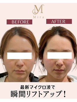 ミラ 札幌店(Mira)の写真/小顔コルギで即効リフトアップ!話題の施術で理想のラインを♪ハイパーナイフ&マイクロウェーブリフトも◎