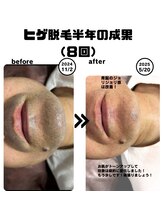 オフ(off)/ヒゲ脱毛