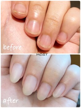 モスト(MOST)/深爪矯正