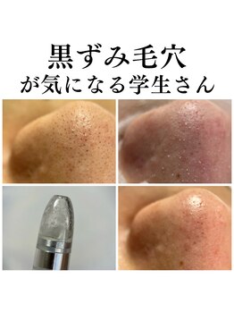 フェリス(FELIZ)/話題の韓国式３D毛穴洗浄