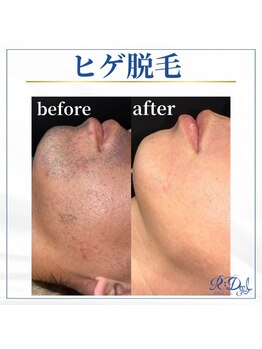 デール(R:DeeL)/メンズ脱毛が人気