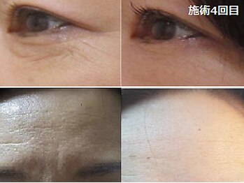 ナチュレアンドメディカ(Nature&Medica)/小じわ集中ケア(Wフェイシャル)