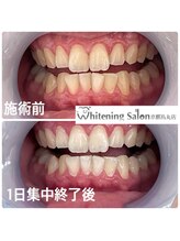 ホワイトニングサロン 京都烏丸店/ホワイトニング施術例