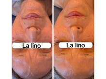 ラ リノ 星ヶ丘(La Lino)/シワ予防、たるみ改善