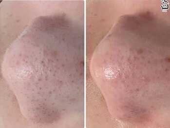 5つ星/◆ハイドロ毛穴洗浄