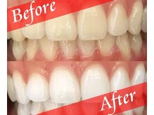 【歯科提携】1日でできるだけ白く★モテる男に！！