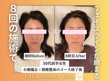 ルルラボ(LuLu beauty labo)/フェイスライン引き締め