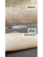 エクボ(EcBeau)/全身脱毛お客様提供写真