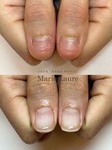 マリーロール 梅田店(Marie Laure)/自爪育成/深爪矯正/ネイルケア