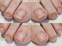 ニコプラス(NICO+)/フット爪育ネイルケア