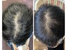 【育毛促進】頭皮が見始める前に【ヘアブースト】トニック付￥43780→￥35000