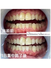 ホワイトニングサロン 京都烏丸店/ホワイトニング 施術例