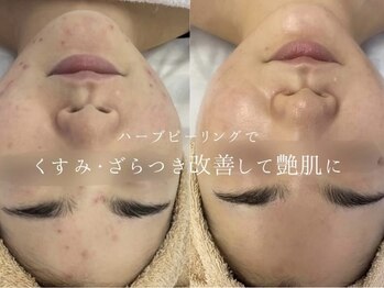 オーパーツ(OOPARTS)/ハーブピーリング/エステ/下北沢