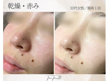 スリースリー(THREE THREE)/乾燥・赤みケア