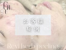 サロンドチュラ(salon de chula)/症例写真のご紹介♪/韓国肌管理