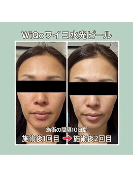 プティ カシェット 伊丹店(petit cachette)/ワイコwiqoビフォー・アフター5