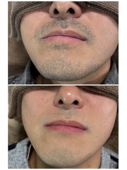 カピリナ(kapilina)/ヒゲ脱毛５回目で清潔感アップ