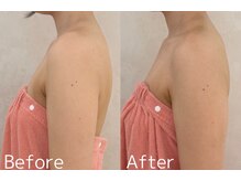 カレンジェビューティー(CarengeBeauty)/巻き肩、姿勢改善