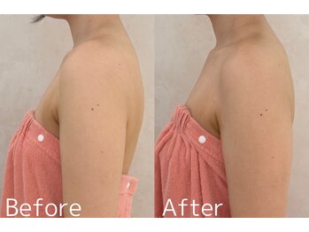 カレンジェビューティー(CarengeBeauty)/巻き肩、姿勢改善