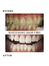 ホワイトニングショップ 千葉店/歯科提携　ホワイトニング専門店