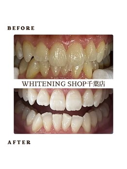 ホワイトニングショップ 千葉店/歯科提携 ホワイトニング専門店