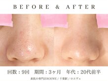 ロエヴェ(ROEWE)/ニキビ改善・毛穴ケア・肌質改善