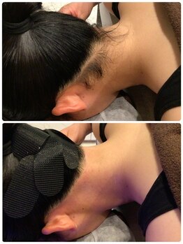 ビープラス(B plus)/効果長持ちうなじMIX脱毛☆