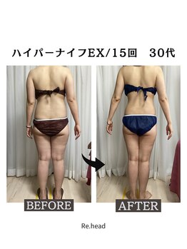 リヘッド(Re.head)/ハイパーナイフEXで全身痩身