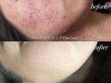 アンドナイン エス店(ANDNINE.)/毛穴洗浄+ハーブピーリング4回