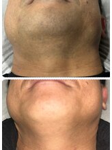 ラヴィエール(Laviere)/【メンズ脱毛】お髭