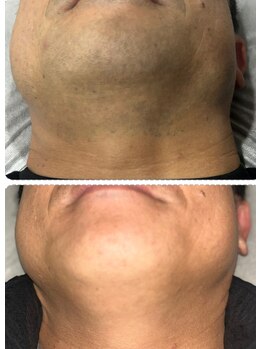 ラヴィエール(Laviere)/【メンズ脱毛】お髭