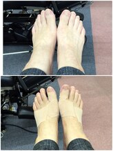 あい鍼灸 接骨院 袋原院/フットケアビフォーアフター