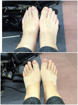 あい鍼灸 接骨院 袋原院/フットケアビフォーアフター