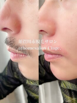 シアージュ(ciage.)/広範囲ひげワックス脱毛