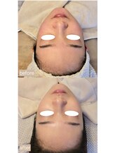 ムーフ(Moof)/Moof式細胞活性術メニュー